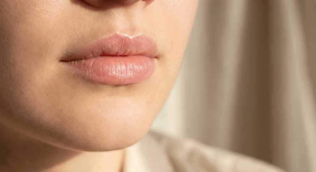 Labios con aumento natural y perfilado suave tras tratamiento con ácido hialurónico