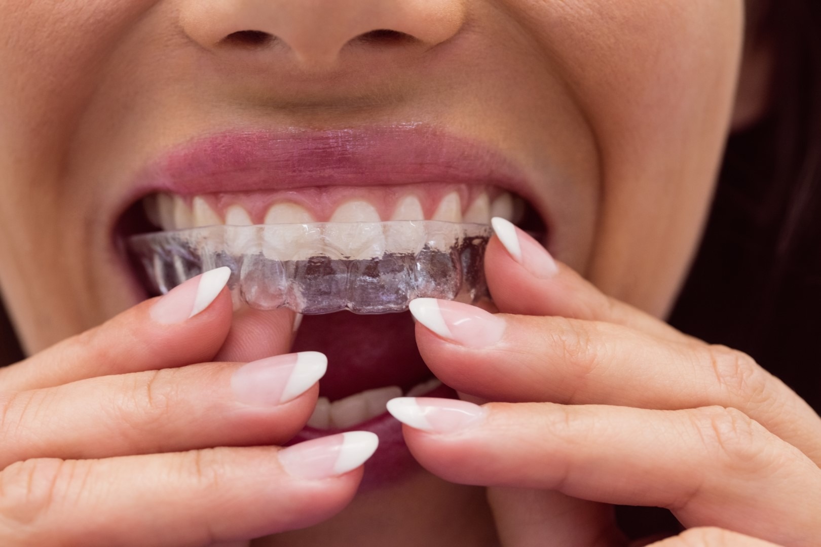La ortodoncia invisible es la alternativa más estética que existe actualmente a los brackets tradicionales.