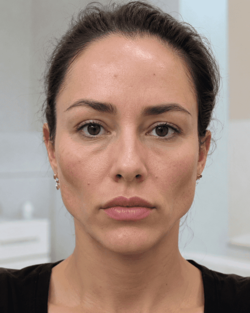 Primer plano de mujer con volumen facial marcado en mejillas y labios