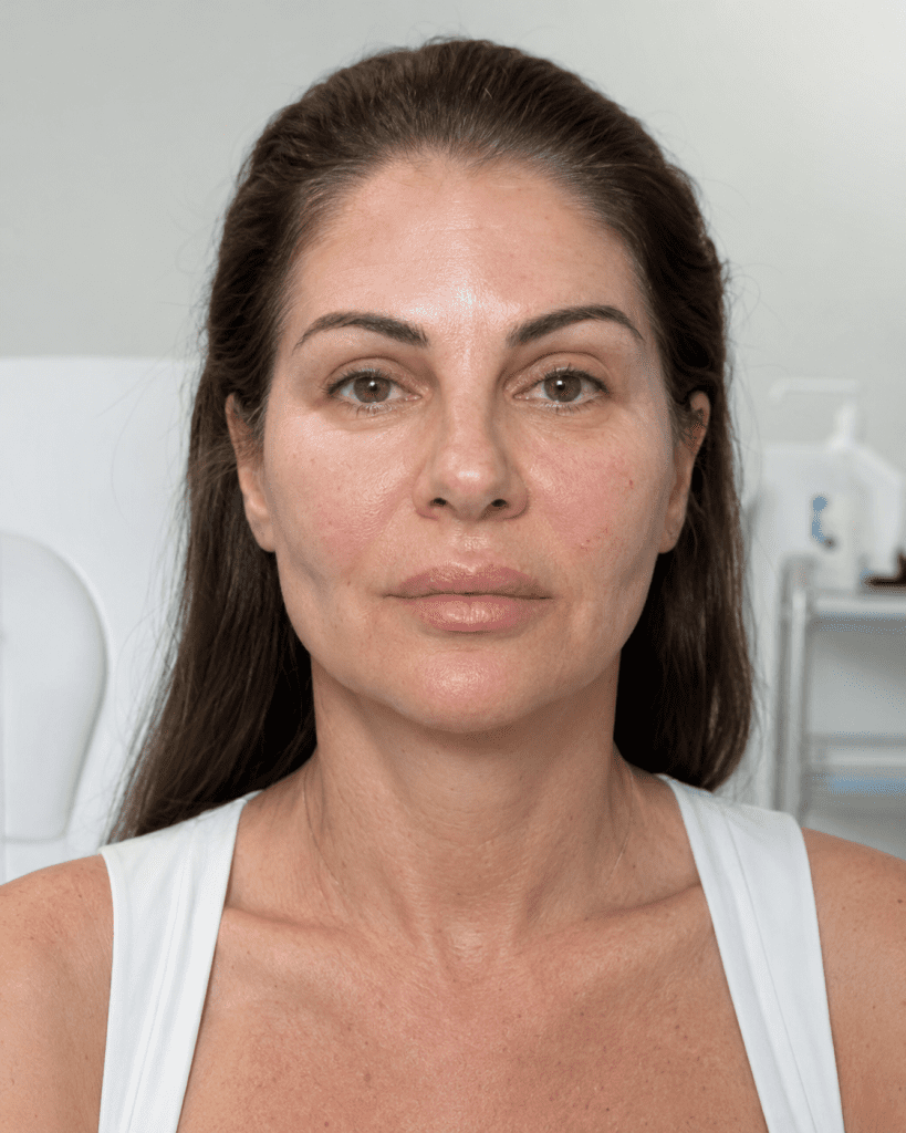 Mujer en consulta estética con aumento de volumen en mejillas y labios