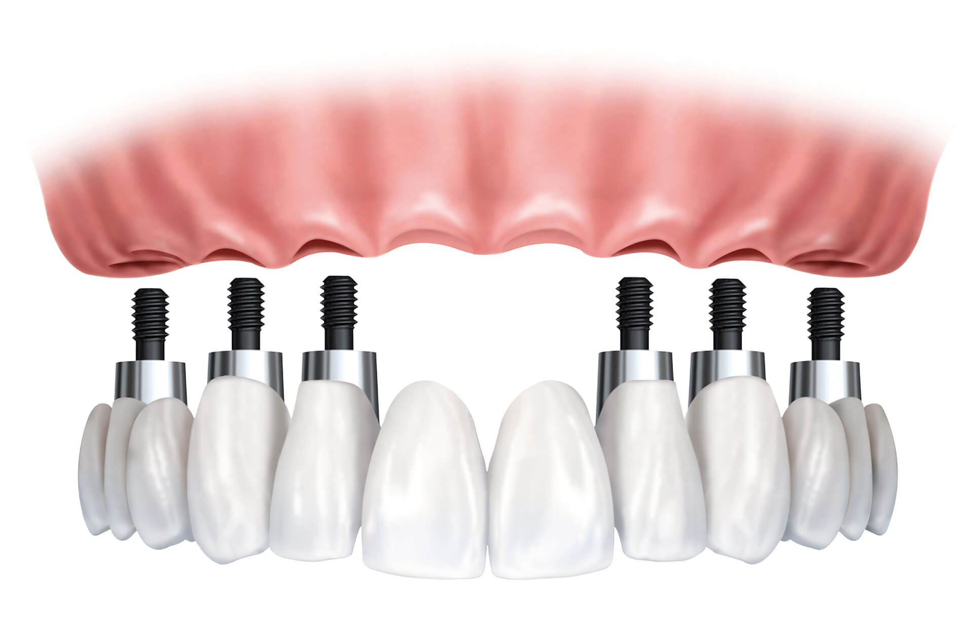 img tratamiento dental implantes clinica pereira sevilla 1