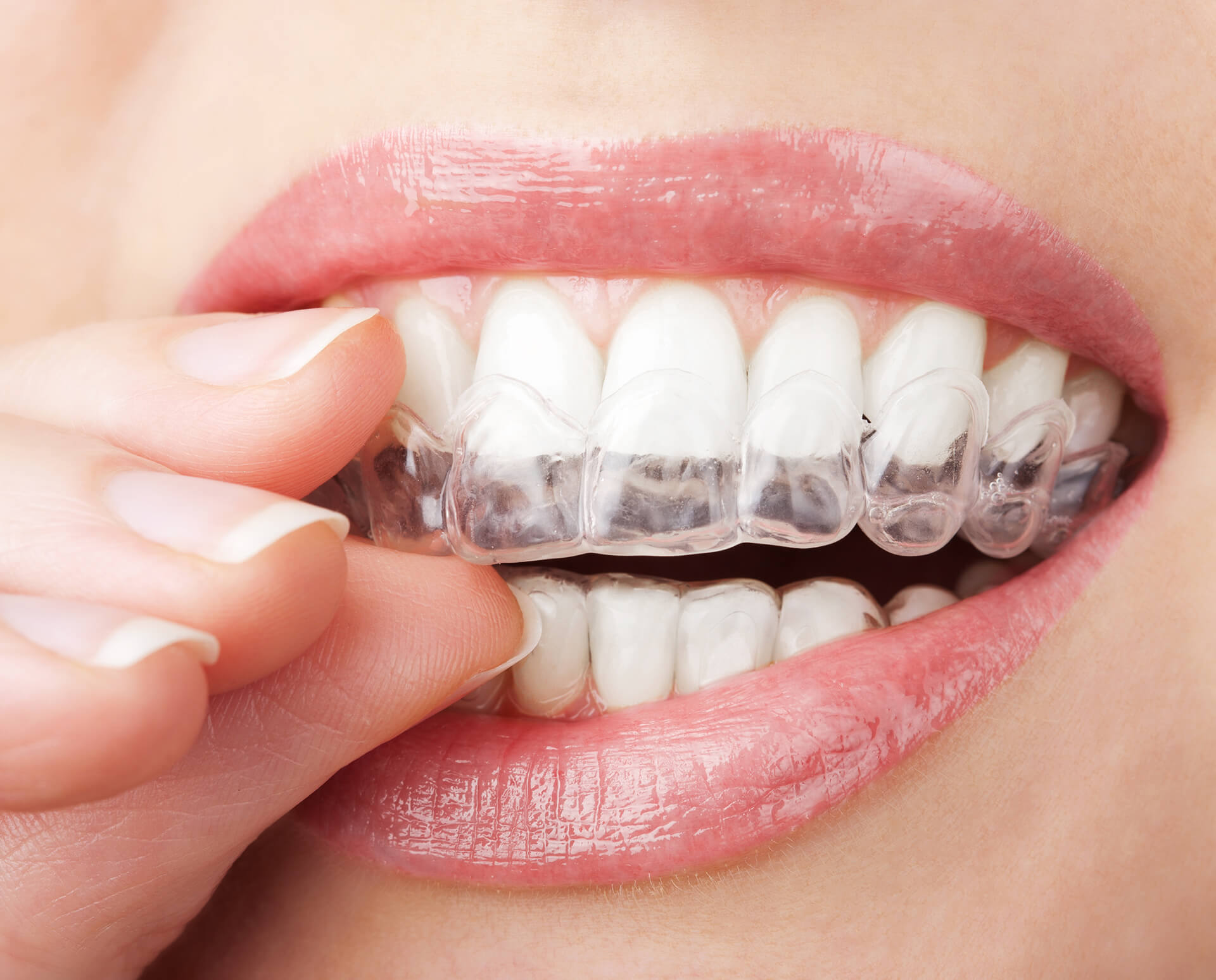img tratamiento dental protesis clinica pereira sevilla
