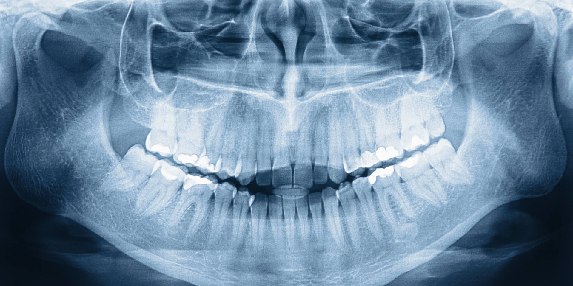 img tratamiento dental radiografia clinica pereira sevilla